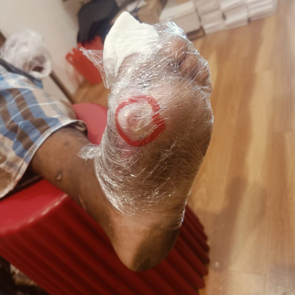  Mr. Kannabiran’s Journey: Finding Relief with Offloading Shoes for Diabetic Foot Ulcer